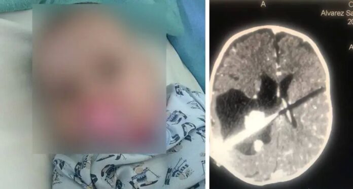 “No hay neurocirujanos ni anestesistas”: padres de bebé con tumor en la cabeza ruegan por operación para su hija