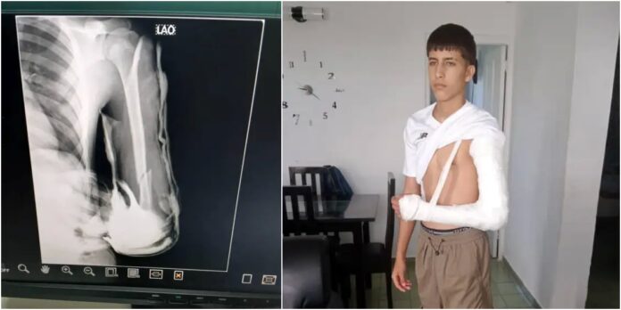 “Lo agarraron entre dos”: Policías fracturan brazo a adolescente holguinero 