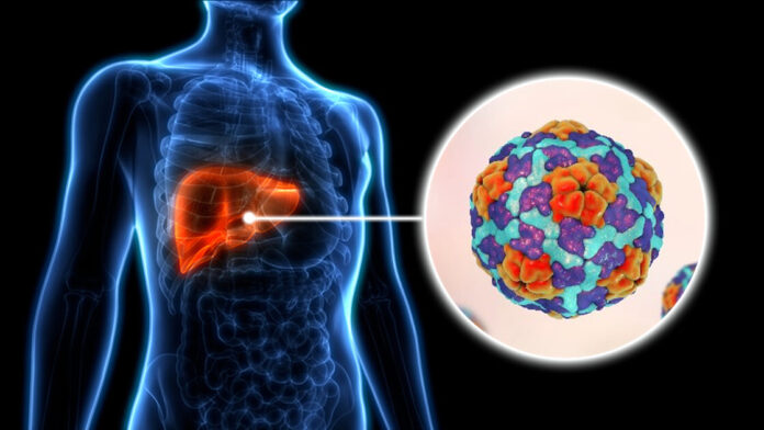 Alza de casos de Hepatitis A en Cuba: informan sobre situación epidemiológica